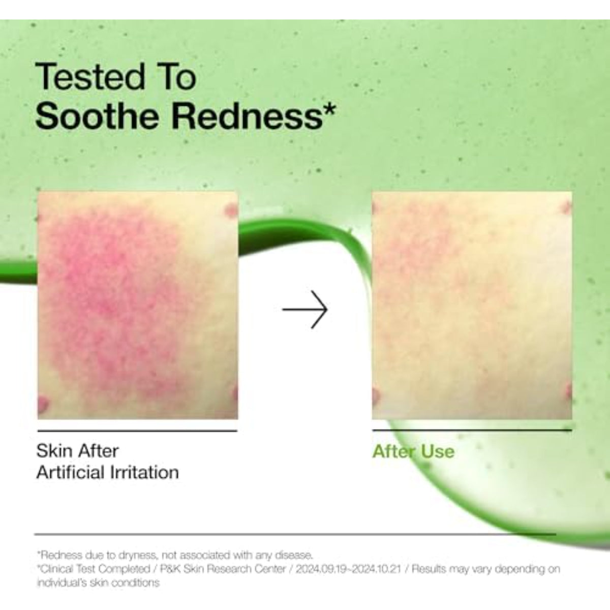 Azelaic Acid 10 Serum – Redness Soothing, Hyaluronic Acid, Niacinamide, Vegan Korean Skincare 30ml